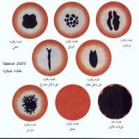 عملية الترقيع لغشاء البكارة للفتيات