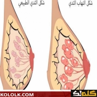 التهاب الثدي اسبابه و طرق علاجه