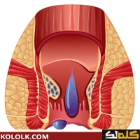 علاج و دواء انتفاخ البواسير الخارجيه بالأدويه وبدون جراحة