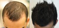 كيف تتم عملية زراعة الشعر