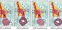 مراحل تطور سرطان الثدي