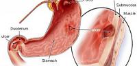 تعرف على ما هى علامات و دلائل قرحة المعدة
