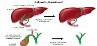 غذاء ما بعد عملية المرارة