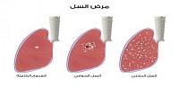 تعرف على ما هى أنواع أمراض الرئة