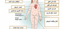 تعرف على ما هى متلازمة تيرنر