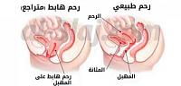 تعرف على ما هى أعراض نزول الرحم