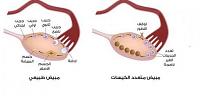 تعرف على ما هى ما هى اسباب وجود كيس على المبيض