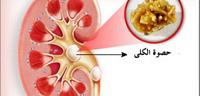 تعرف على ما هى أعراض رمل الكلى