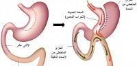 تحويل مسار المعدة