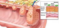 سرطان المستقيم وعلاجه